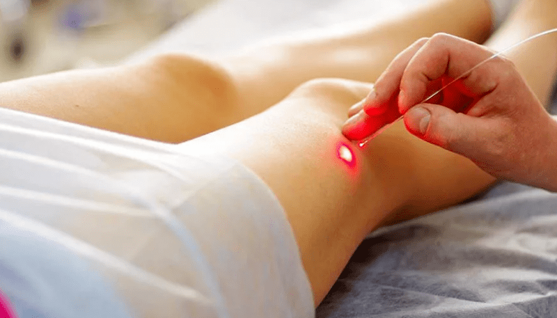Laser coagulation of varicose veins