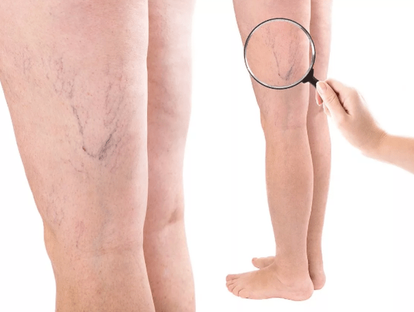 Varicose veins in women