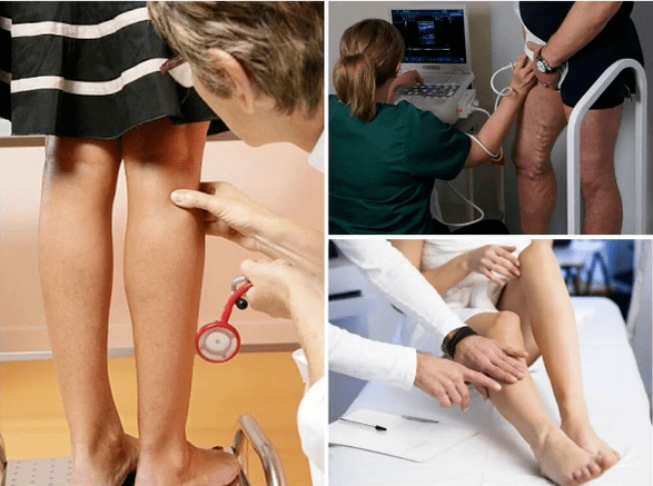 Varicose veins on the legs