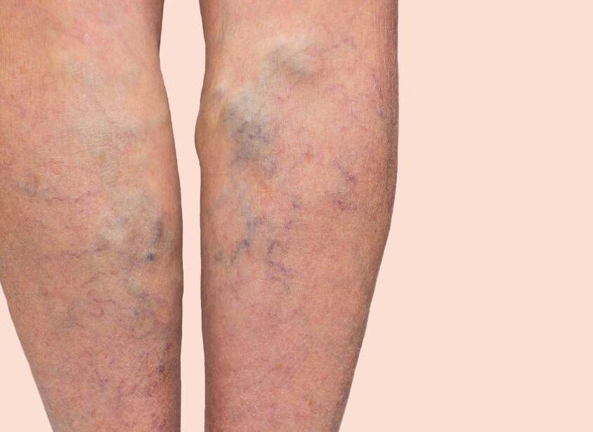 How do varicose veins look