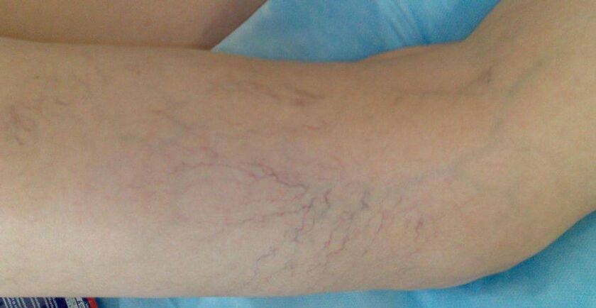 Vascular stars on the legs