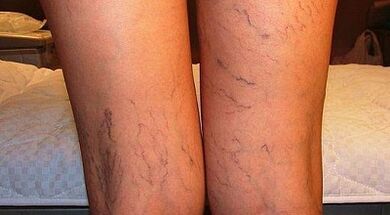 How to treat the Varicon expansion of women in women