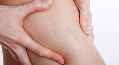 Signs and symptoms of varicose veins