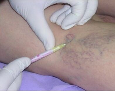 Injections against varicose veins