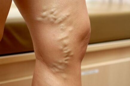 Medication for varicose veins
