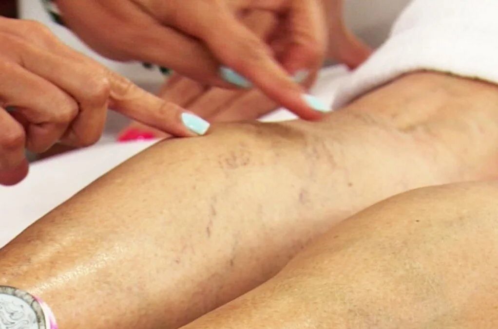 Examination of legs with varicose veins