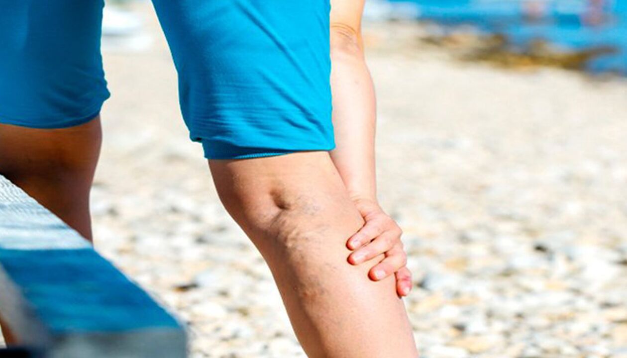 Leg pain with varicose veins