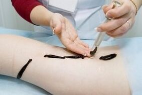 Using leeches to treat varicose veins