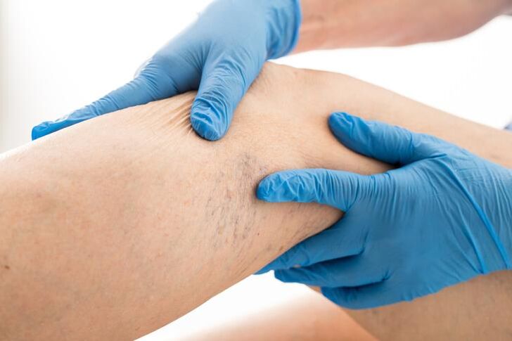 Doctor examining legs with varicose veins