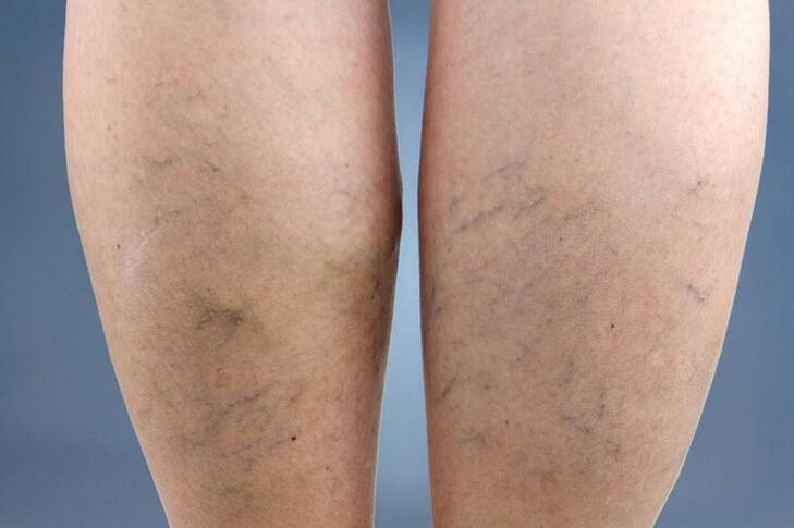 Symptoms of varicose veins in the legs