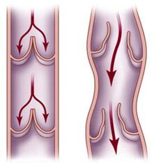 Healthy vein and impaired blood flow in a varicose vein