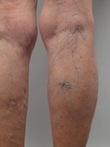 In varicose veins of the lower extremities, tortuous veins protrude above the surface of the skin