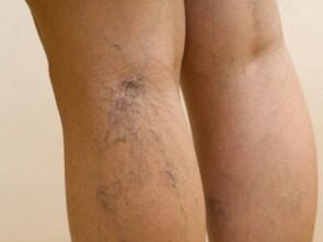 Veins protruding under the skin are a symptom of varicose veins on the legs